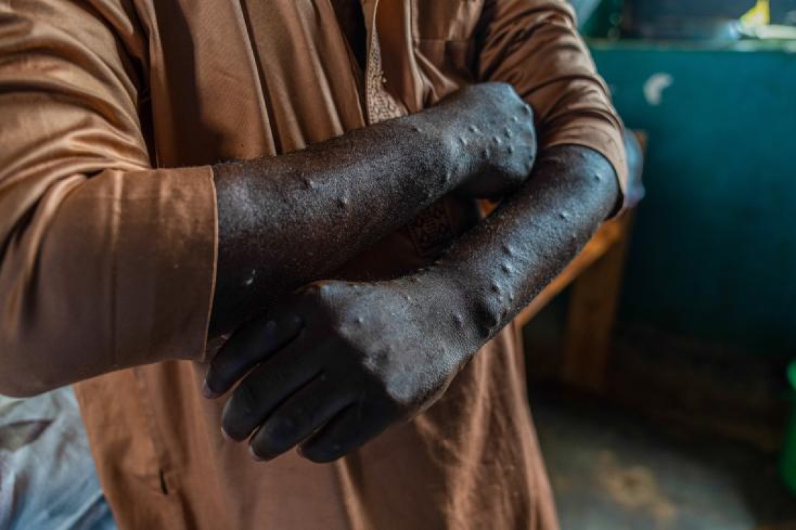 Mpox : le nouveau variant se transmet surtout entre humains