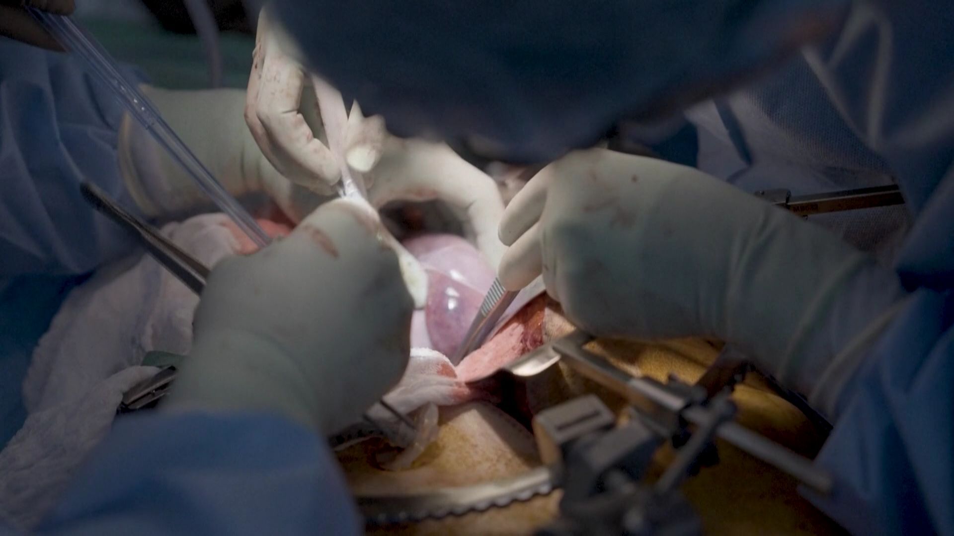 Greffe de rein de porc : deux essais cliniques approuvés aux États-Unis