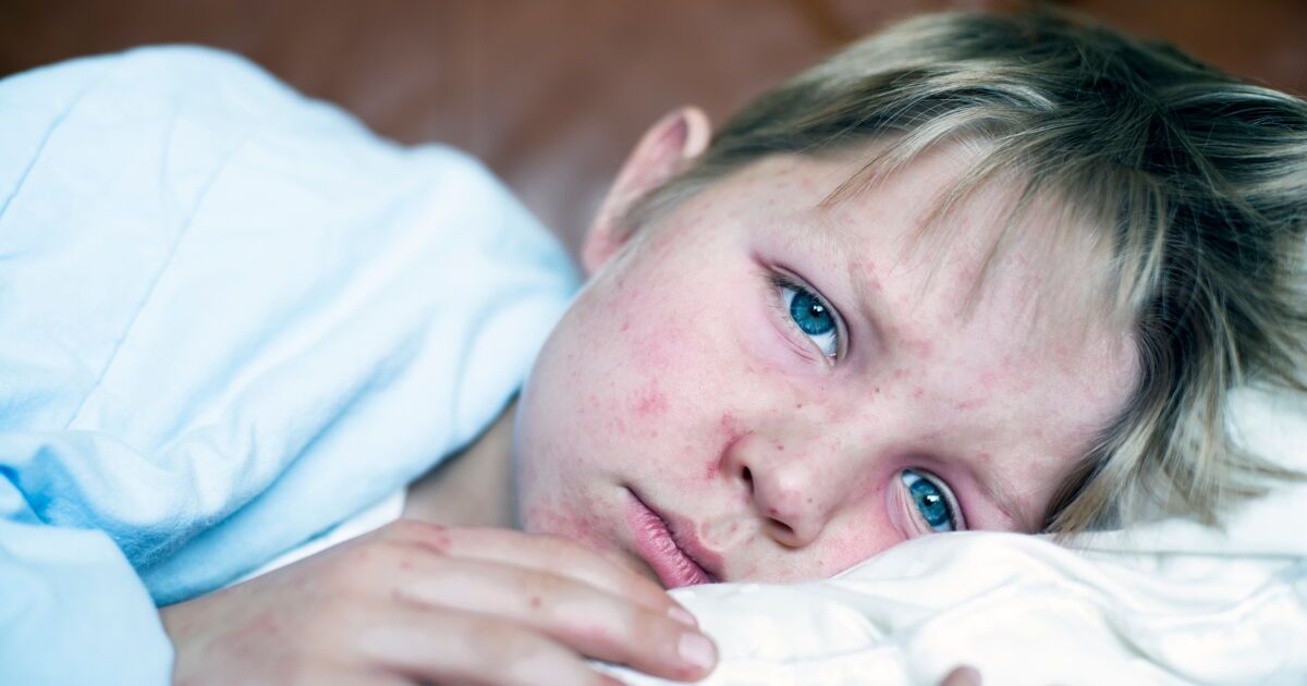 Hausse des cas de rougeole en Europe : l’OMS tire la sonnette d’alarme