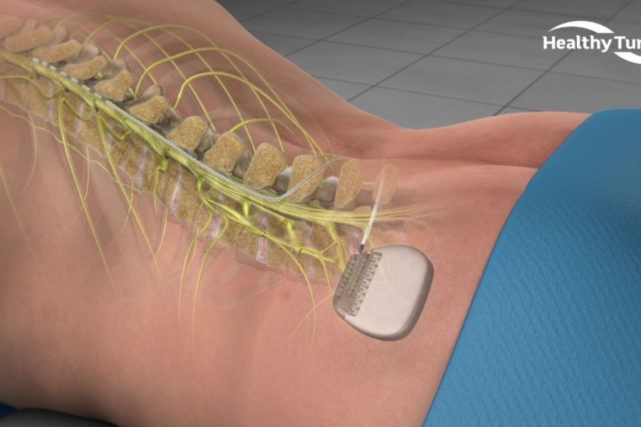 Neuro-Révolution : Le premier Implant de Moelle Épinière testé en Europe